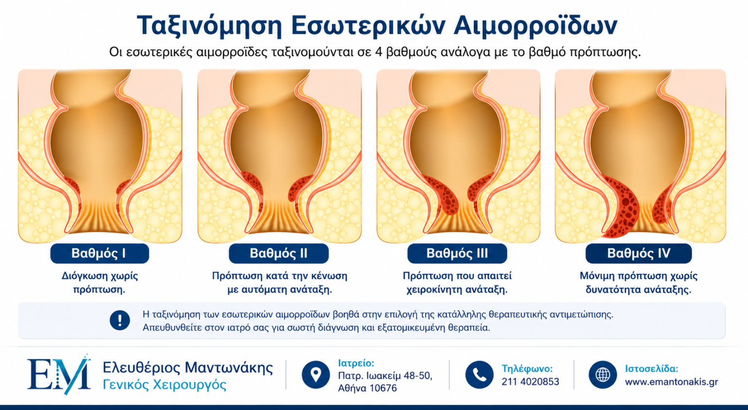 Βαθμοί εσωτερικών αιμορροΐδων και αιμορροϊδοπάθεια.