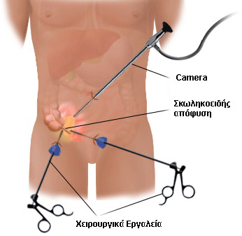 Λαπαροσκοπική σκωληκοειδεκτομή
